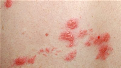 مرض الحزام الناري، أسباب الإصابة والأعراض وطرق العلاج