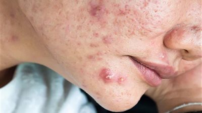  علاجات آثار حب الشباب، ومتي تذهب للطبيب؟