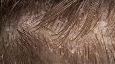 بمكونات بسيطة احصلى على شعر كثيف خالٍ من القشرة