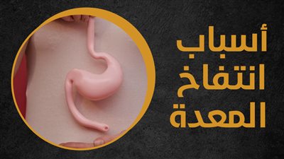  أسباب انتفاخ المعدة (انفوجراف)