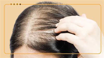 7 أدوية تسبب تساقط الشعر (إنفوجراف)