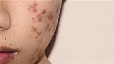 أفضل علاج لحب الشباب، اتبعيه حفاظا على جمال البشرة