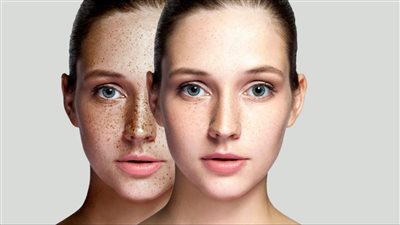 طرق التخلص من النمش في البيت بالمواد الطبيعية