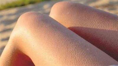 وصفة طبيعية لعلاج جلد الوزة وتنعيم البشرة