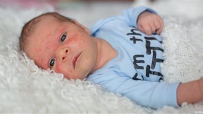  أحدهم قد يؤدي للوفاة، الفرق بين عدم تحمل اللاكتوز وحساسية الألبان