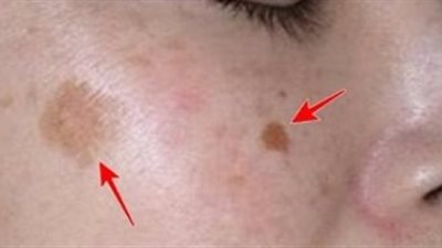 كلها من مطبخك، وصفات للتخلص من البقع الداكنة