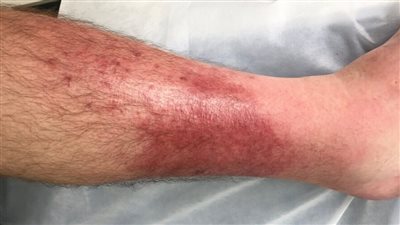 ماذا تعرف عن مرض الحمرة، وأين يظهر في الجسم؟