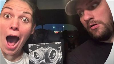 حالة واحدة بين كل 5 ملايين، حامل في توأم كل منهما ينمو في رحم 