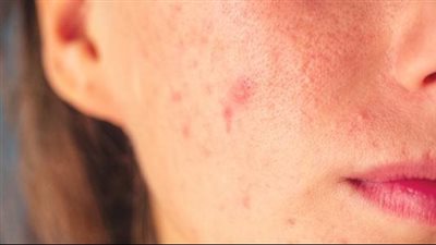 وصفة طبيعية لعلاج حب الشباب بدقيق الحمص