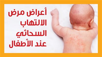 أعراض مرض الالتهاب السحائي عند الأطفال (إنفوجراف)