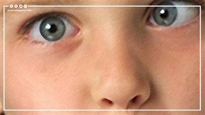 5 تعليمات مهمة لحماية الأطفال من الإصابة بالحول 