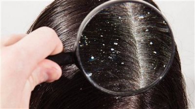 علاج قشرة الشعر في المنزل بزيت شجرة الشاي والليمون 