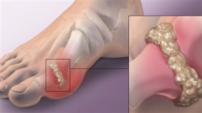 ما هو النقرس الكاذب، وما تأثير حمض اليوريك على العظام؟