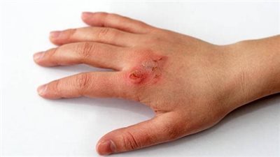 أسباب الإصابة بقرح الفراش، وهل يمكن أن تسبب الوفاة؟