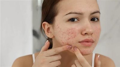 قناع الحليب والزبادي لعلاج حب الشباب والقضاء على آثارها بالبشرة