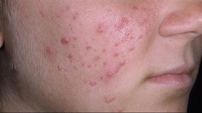 وصفة طبيعية لعلاج حب الشباب وآثاره بالبشرة
