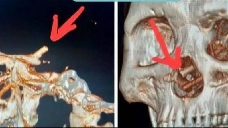  جمجمة رجل فيتنامي