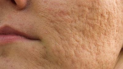 تخلصي من آثار حب الشباب والندبات بخل التفاح 