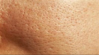 وصفة طبيعية للتخلص من الرؤوس السوداء 