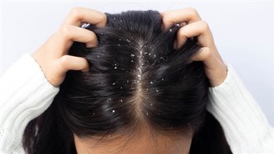 أسباب ظهور قشرة الرأس بكثرة في الشتاء