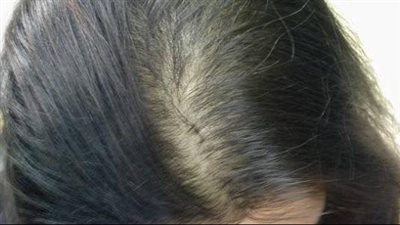 وصفة طبيعية لعلاج الشعر الخفيف والمتساقط