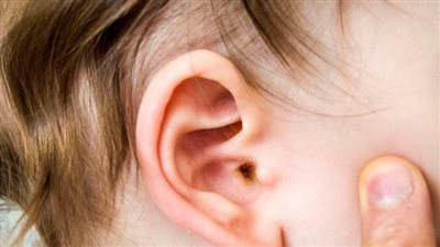 استشارى: الزكام سبب رئيسي في الإصابة بالتهابات الأذن الوسطى عند الأطفال 
