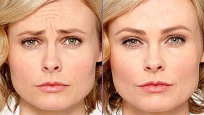 بوتكس اللبان الدكر لبشرة شباب وأكثر نضارة 