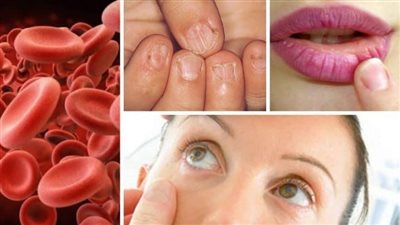 أعراض الأنيميا الحادة وأهم أسبابها