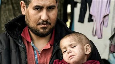 الحرب دمرت رحلة علاجها.. فلسطيني عن ابنته المريضة: أخشى أن أستيقظ وأجدها ميتة