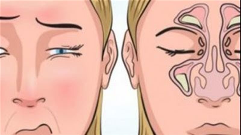 علاج الجيوب الأنفية