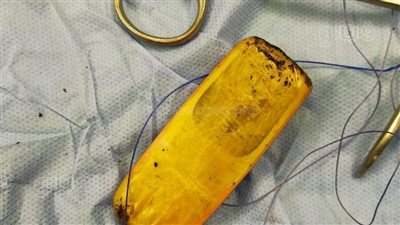 بعد 6 شهور.. تفاصيل استخراج هاتف من معدة مريض في أسوان| صور 