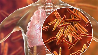 مرض السل.. الأعراض وطرق العلاج