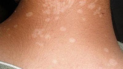 أسباب ظهور بقع ونقط بيضاء على أظافر ووجه طفلك