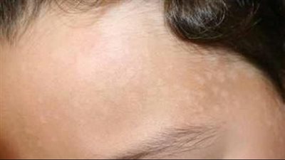 أسباب البقع البيضاء عند الأطفال، وطرق علاجها