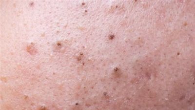 قناع بيكربونات الصوديوم للتخلص من البثور السوداء وغلق المسام الواسعة 