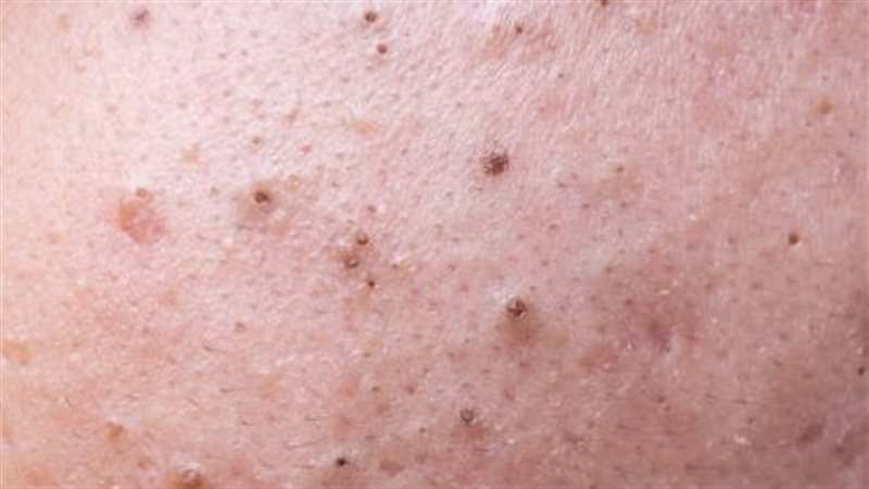علاج البثور السوداء،