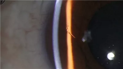 يعيش 15 عاما، بشظية خشبية في قرنية عينه