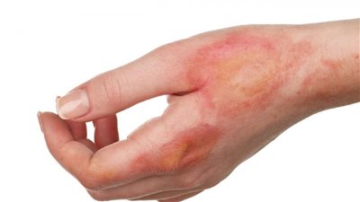 علاج قرح الفراش في المنزل وأسباب الإصابة بها