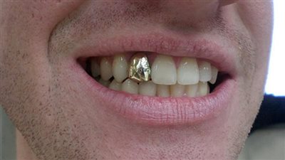 ما حكم حشو الأسنان بالذهب؟ الإفتاء تجيب