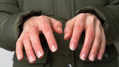 أسباب برودة الأطراف في موسم الشتاء