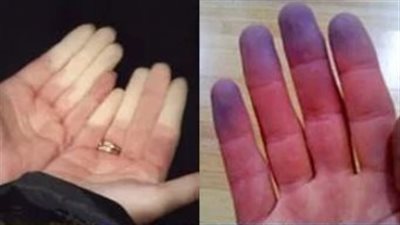 جمال شعبان: برودة الأطراف تنذر بأمراض خطيرة