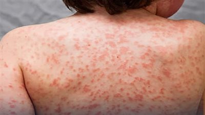 يصيب الأطفال تحت سن الـ 5 سنوات، أهم أعراض مرض كاواساكي