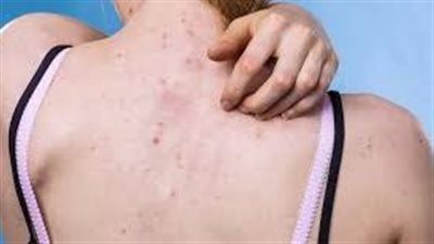  علاج حب الشباب يسبب أفكار انتحارية، وما هي خيارات العلاج الأخرى من الصيدلية؟