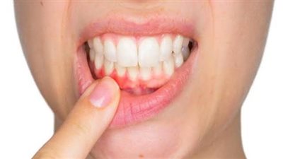 أهمها التدخين والتقدم في العمر، أسباب وعلاجات التهاب اللثة