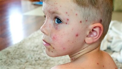 أعراض الجدري لدى الأطفال والبالغين، وكيفية علاجه بالمنزل