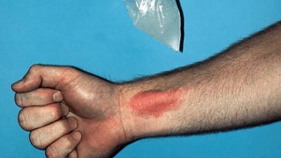 أبرزها الثلج، خرافات ووصفات منزلية لعلاج الحروق قد تؤدي إلى العدوى