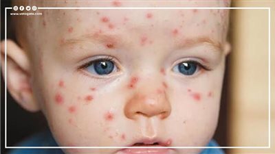 حذرت منه وزارة التربية والتعليم.. ما تريد معرفته عن مرض الجدري المائي (إنفوجراف)