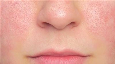 تونر طبيعي لغلق مسام البشرة استخدميه مرتين يوميا