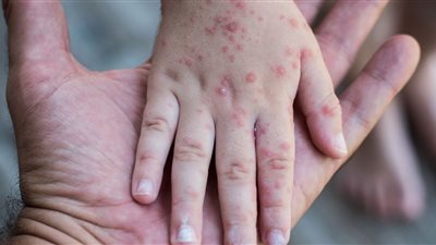 حقيقة انتشار عدوى الجديري المائي بمدارس الجيزة 