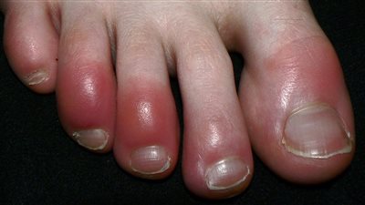 نصائح مهمة للوقاية من عضة البرد في الشتاء (فيديو)